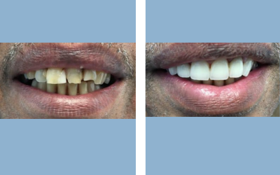Before and After